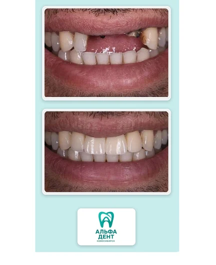 f3f89e0f-7542-4ddd-b317-9bb310db0f5c-alfadent_collage_before.jpg