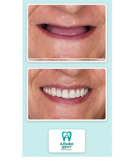 7779ffe3-a026-4b25-84c0-ca71ce9175c9-alfadent_collage_before_after.jpg