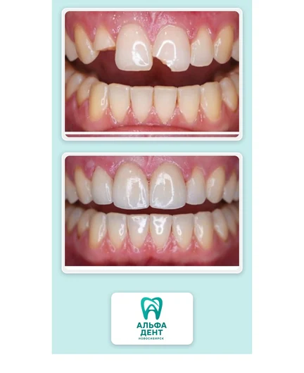 b41f41f8-a4ab-4f6f-b17a-eaf960f073f3-alfadent_collage_before_after_c.jpg